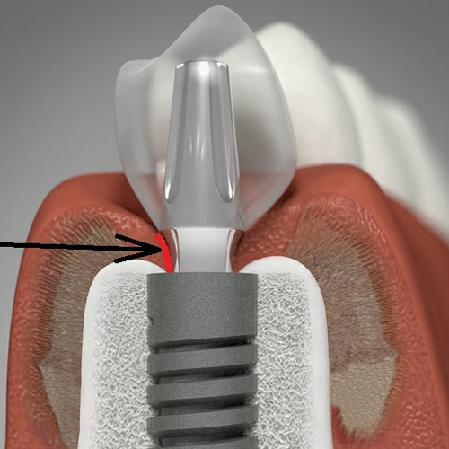 Имплантация зубов в наши дни Имплантация зубов в наши дни